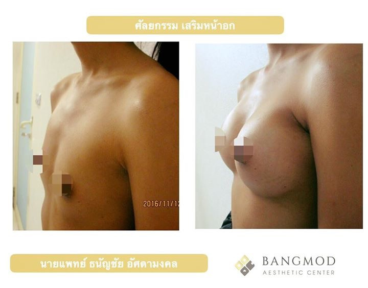 Breast augmentation size C or D? (photos)