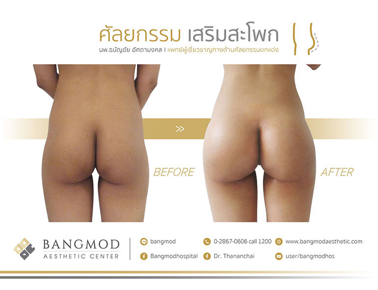 Buttock Augmentation - Naravee Aesthetic Clinic